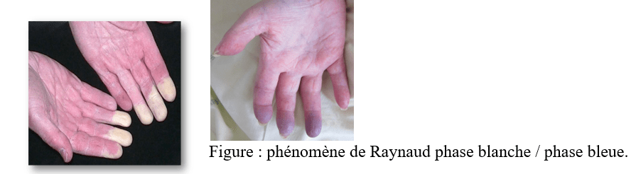 La main sclérodermique - GFRS-Groupe francophone de Recherche sur ...